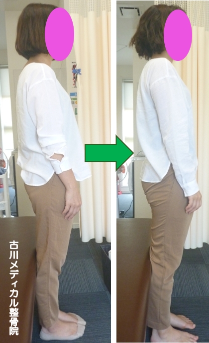 施術効果 ビフォーアフター