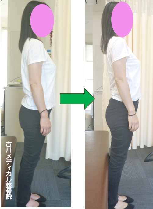 施術効果 ビフォーアフター