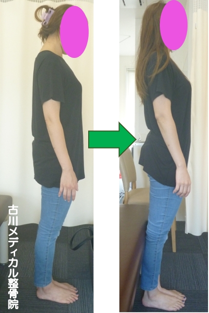 施術効果 ビフォーアフター